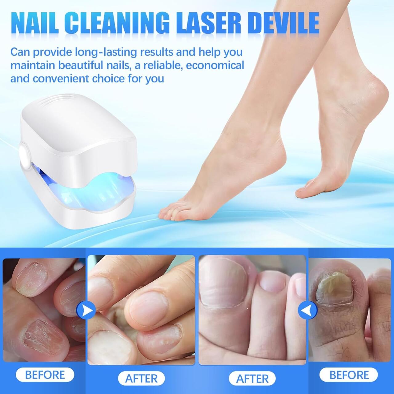 Laser Device for Nail Fungus Treatment